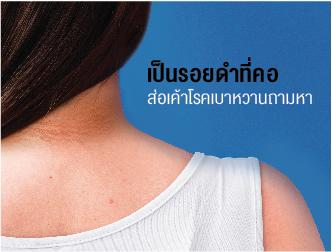 เป็นรอยดำที่คอ ส่อเค้าโรคเบาหวานถามหา